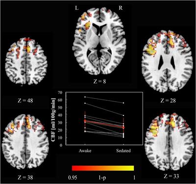 Mild Propofol Sedation Reduces Frontal Lobe and Thalamic Cerebral Blood Flow: An Arterial Spin Labeling Study